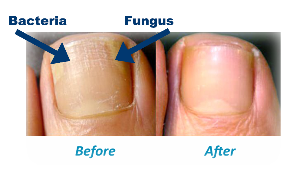 Experience more than 183 bacterial nail infection best